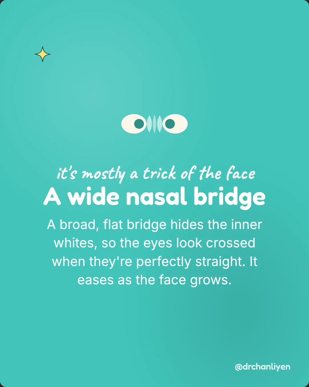 Crossed eyes, or an illusion, slide 2 of 3: It's mostly a trick of the face: a wide nasal bridge. A broad, flat bridge hides the inner whites, so the eyes look crossed when they're perfectly straight. It eases as the face grows.