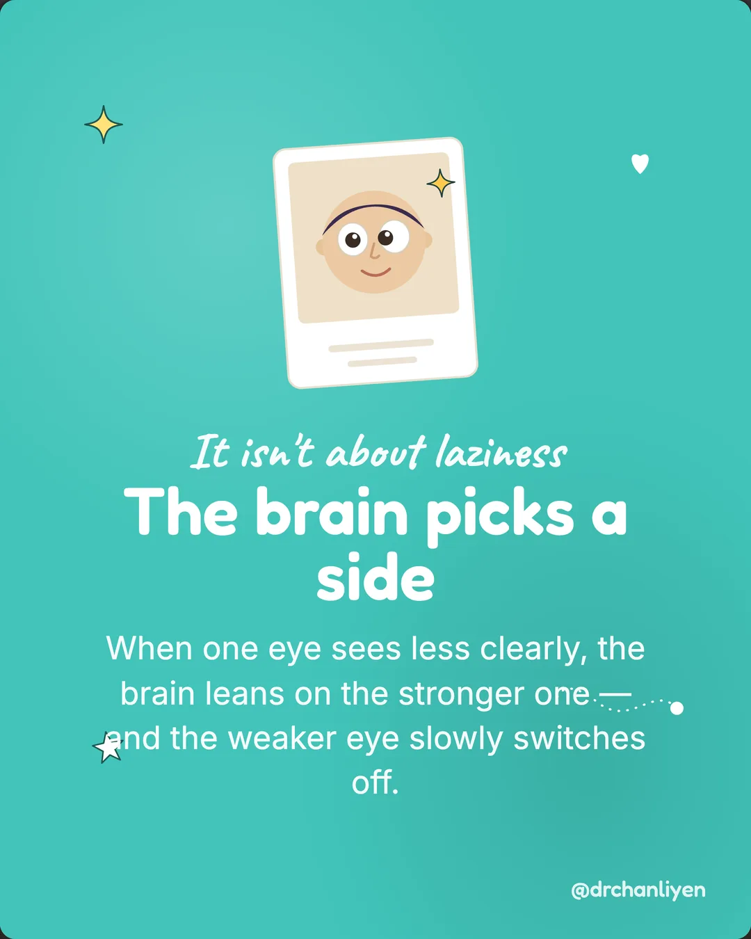 Lazy eye: how to spot it early, slide 2 of 6: It isn't about laziness. The brain picks a side. When one eye sees less clearly, the brain leans on the stronger one, and the weaker eye slowly switches off.