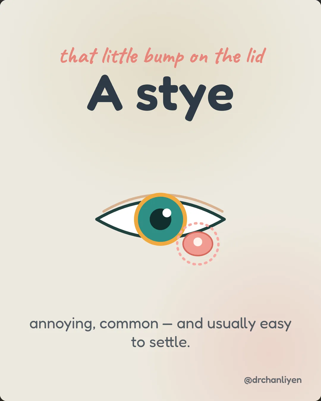 Stye: the warm-compress routine, slide 1 of 3: That little bump on the lid. A stye: annoying, common, and usually easy to settle.