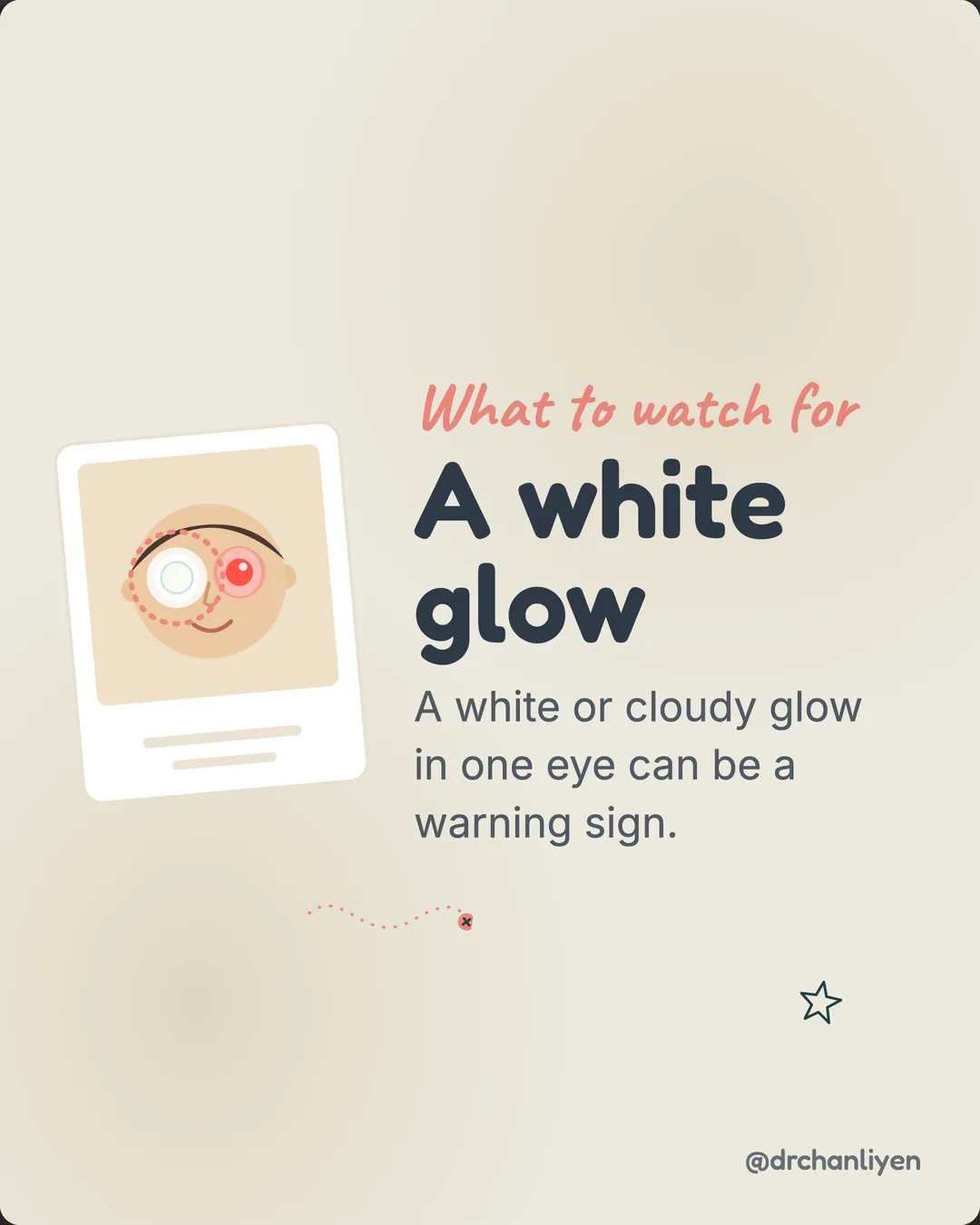 The white glow in photos, slide 3 of 6: What to watch for. A white glow. A white or cloudy glow in one eye can be a warning sign.